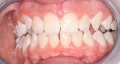 After our no braces treatment din Adelaide