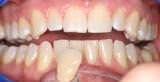 Teeth in Adelaide South before teeth whitening
