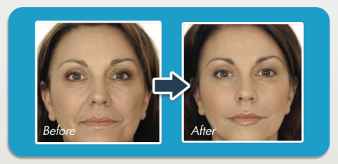 A woman before and after receiving cosmetic injections in Morphett Vale